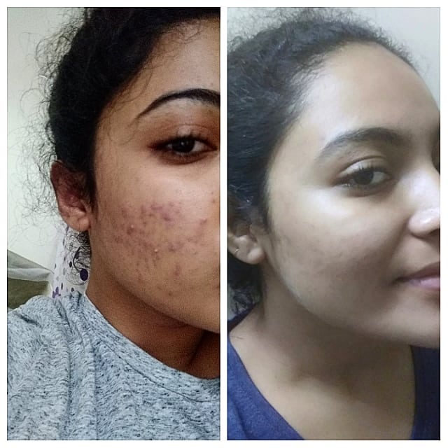 Results Before and After recovery from severe Acne Vulgaris.Mental Health shows physical changes.